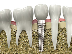 Dental Implants Dental Implants
