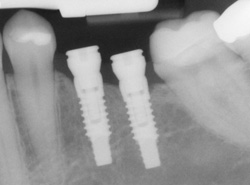 Dental Implants Dental Implants